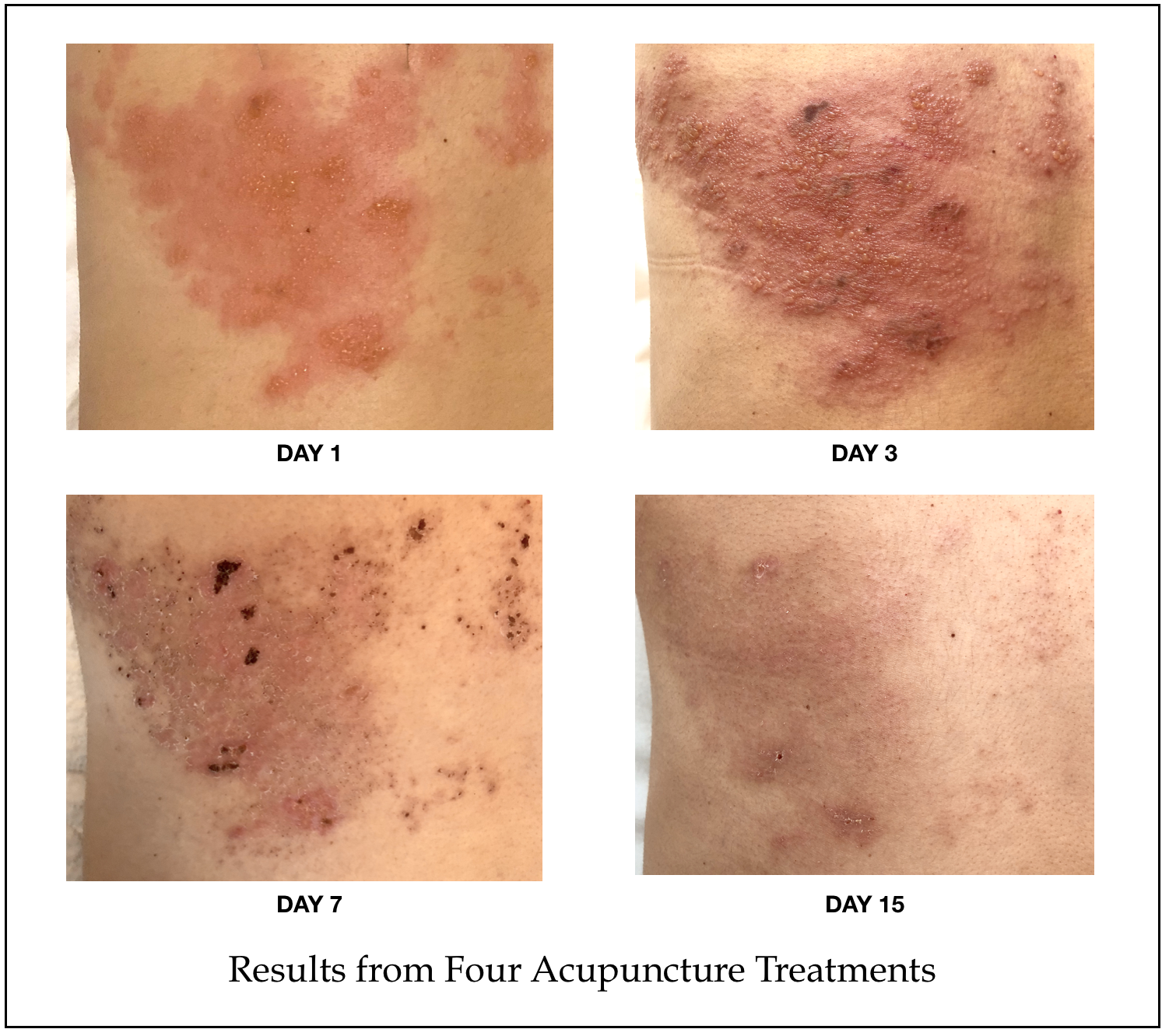 Eczema Shingles Verruca Acupuncture in Brighton Skin Clnic